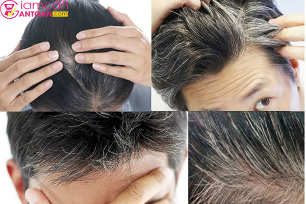 Anti Gray Hair Tình trạng tóc bạc sớm hiện nay ngày càng phổ biến và là nỗi lo của khá nhiều người7050 cải thiện tình trạng tóc bạc sớm, màu tóc vừa đẹp, tóc vừa khỏe.